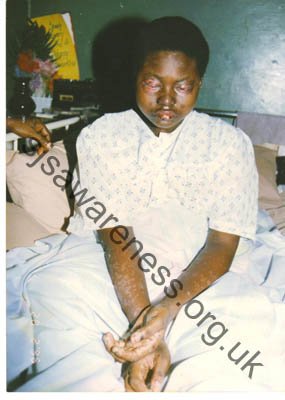 17 year old recovering from stevens -johnson syndrome